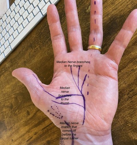 Real hand with the median nerve branches drawn on, showing where carpal tunnel pressure happens